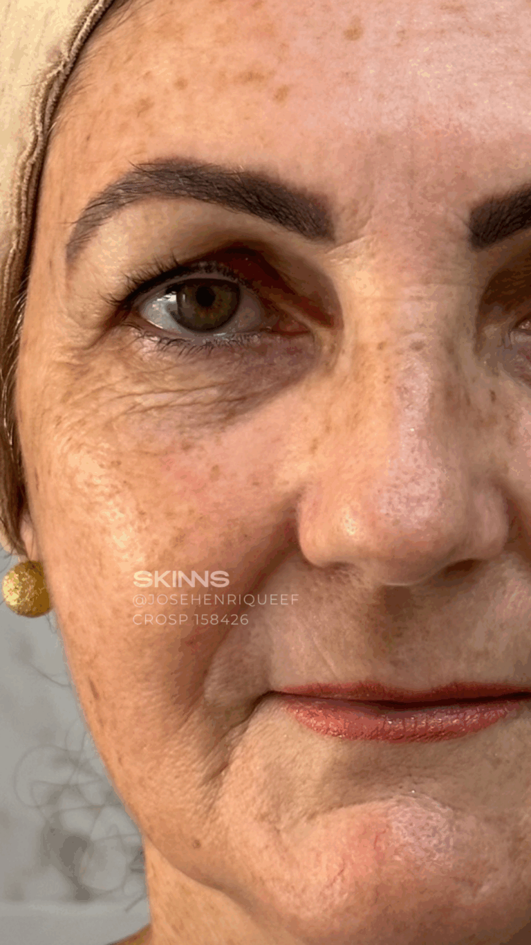 BLEFAROPEEL Resultados.zip - 1