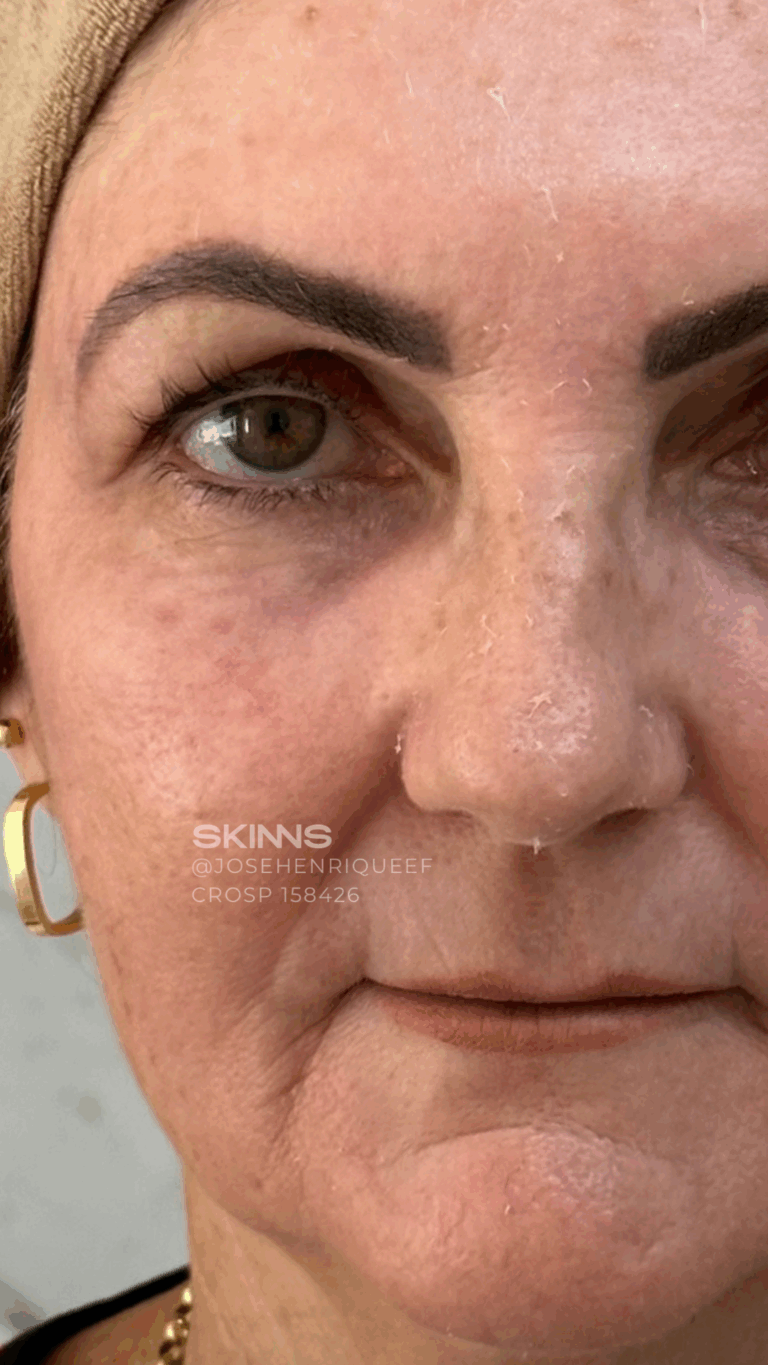 BLEFAROPEEL Resultados.zip - 2