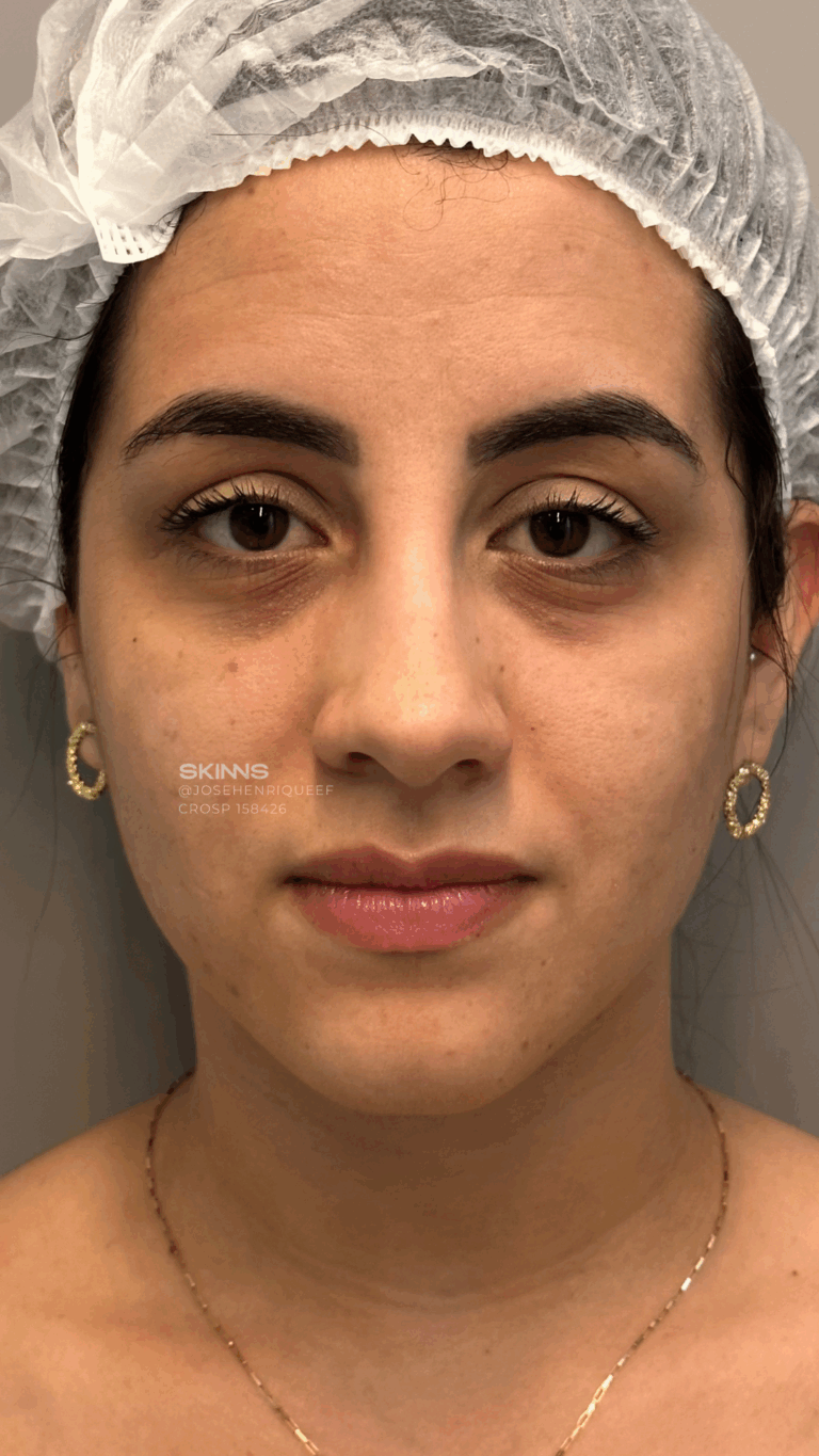 BLEFAROPEEL Resultados.zip - 3