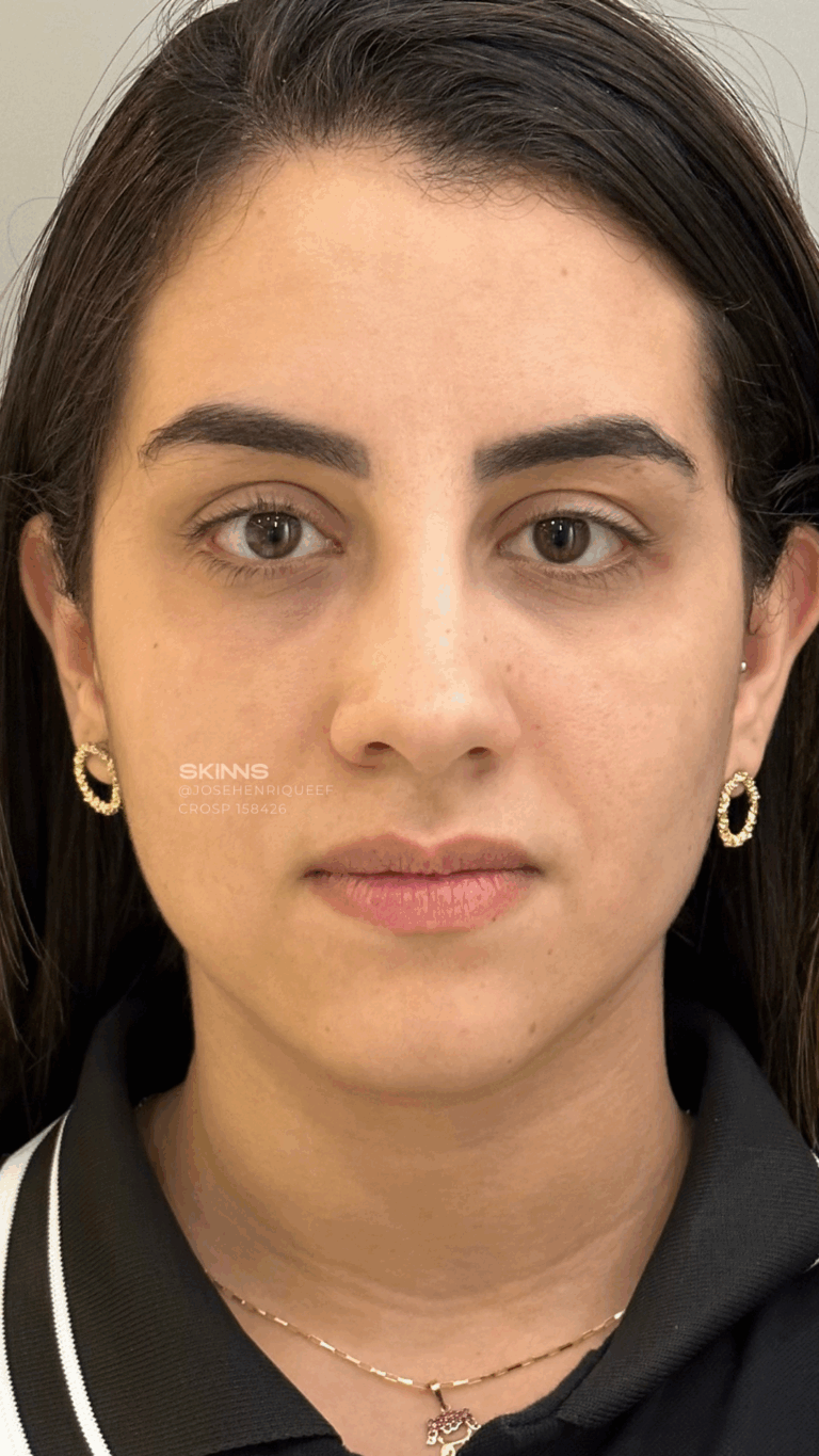 BLEFAROPEEL Resultados.zip - 4