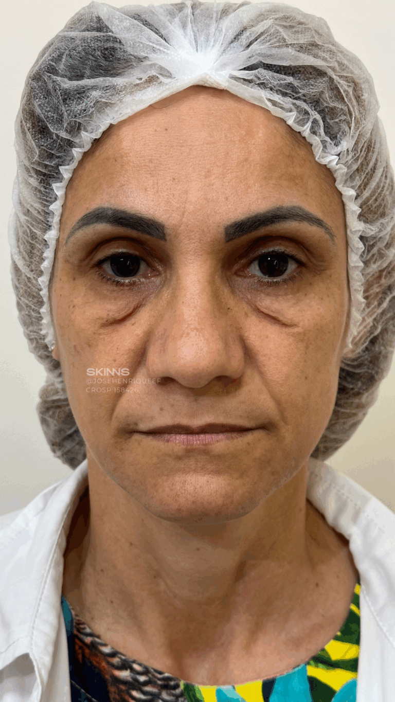 BLEFAROPEEL Resultados.zip - 5