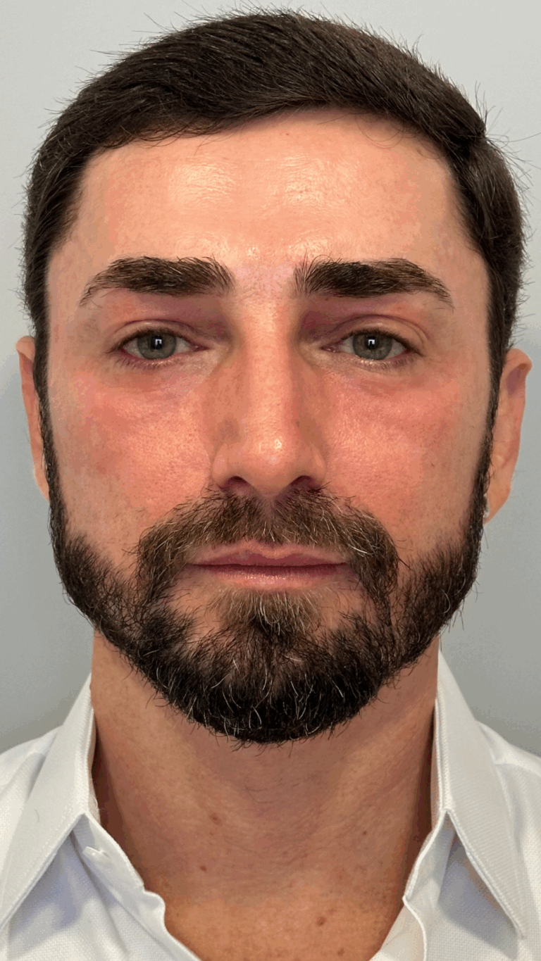 BLEFAROPEEL Resultados.zip - 8