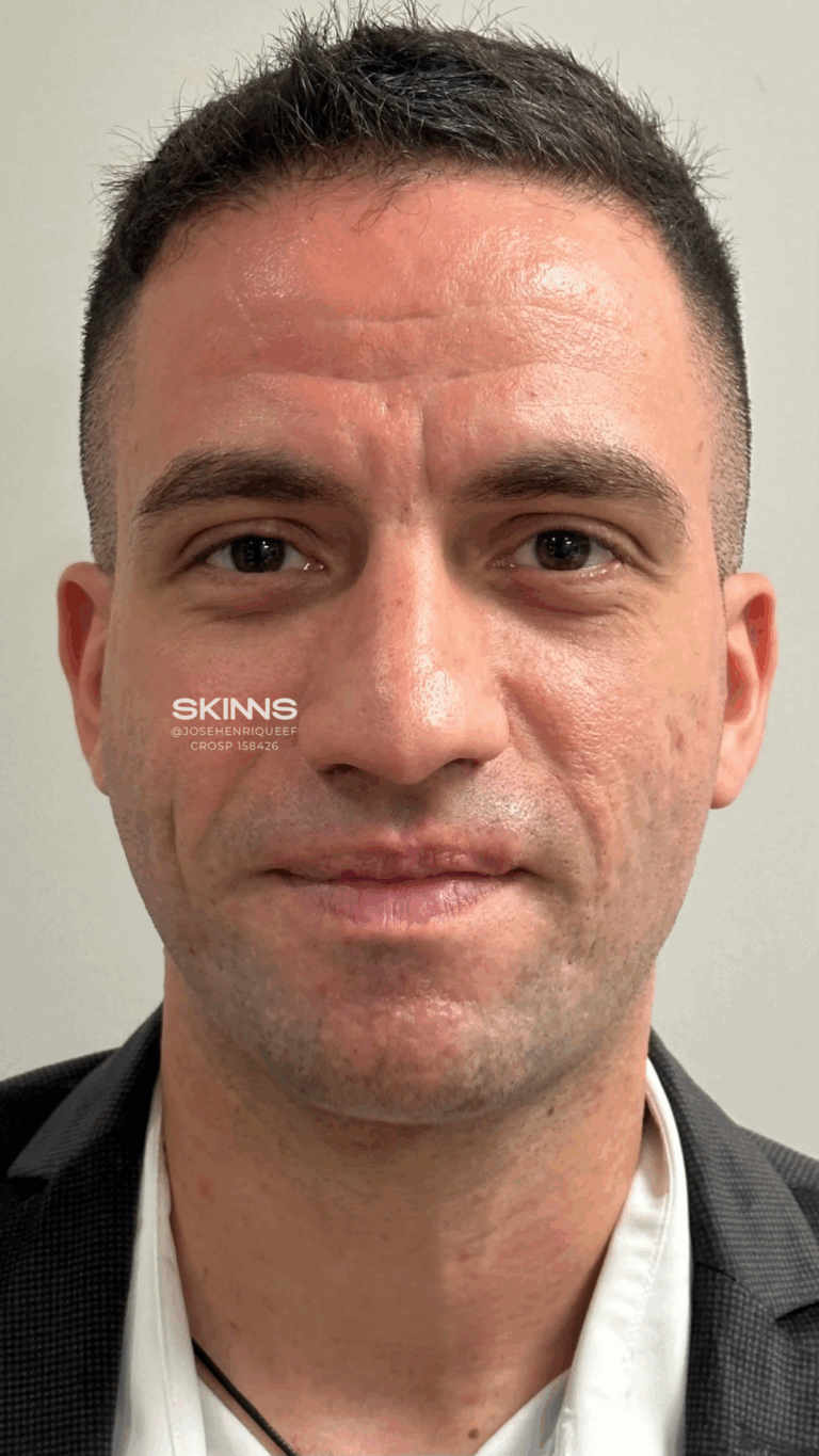 SKIMS POINT Resultados - 1