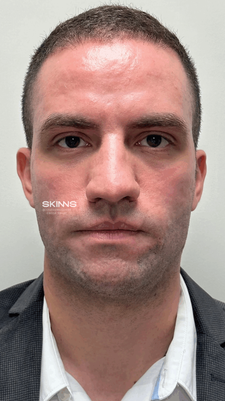 SKIMS POINT Resultados - 2