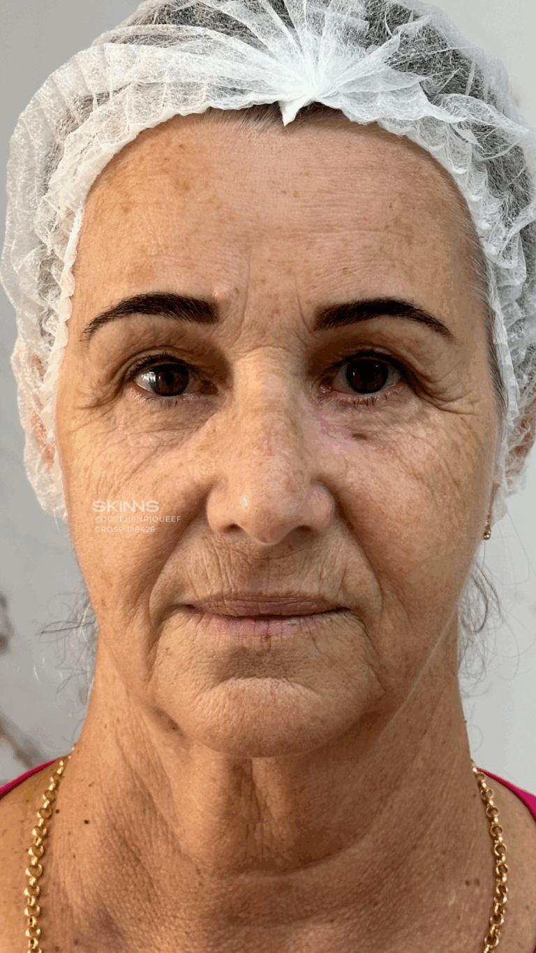 SKIMS Rejuvenescimento Resultados.zip - 14