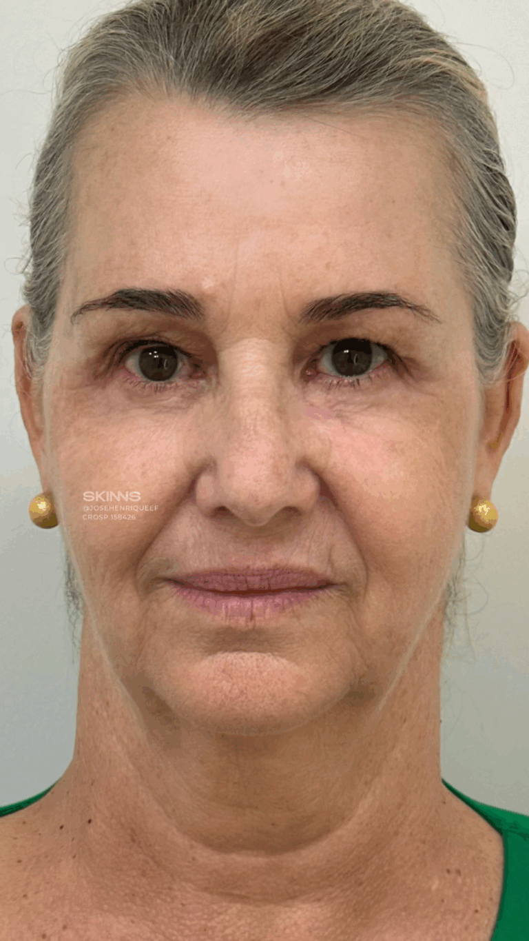 SKIMS Rejuvenescimento Resultados.zip - 15