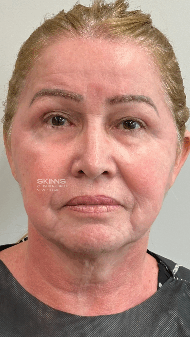 SKIMS Rejuvenescimento Resultados.zip - 4